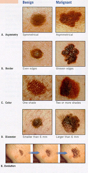 freckles vs moles