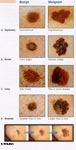 Difference between Moles and Freckles and Melanoma ABCDE Test